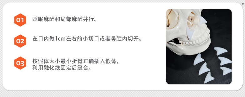 수면마취와 국소마취를 병행하여 시행합니다. 입안쪽에 1cm정도의 작은 절개를 하거나 혹은 콧볼안쪽절개를 이용합니다. 보형물의 크기에 맞는 최소 박리를 통해 정확하게 보형물을 삽입하고 녹는실을 이용하여 고정후 봉합합니다.