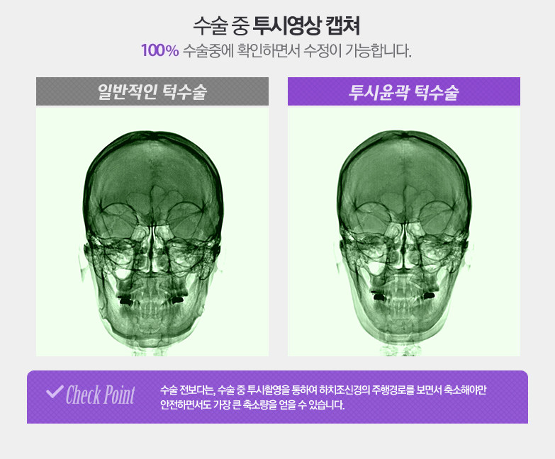 수술 전보다는, 수술 중 투시촬영을 통하여 하치조신경의 주행경로를 보면서 축소해야만 안전하면서도 가장 큰 축소량을 얻을 수 있습니다.