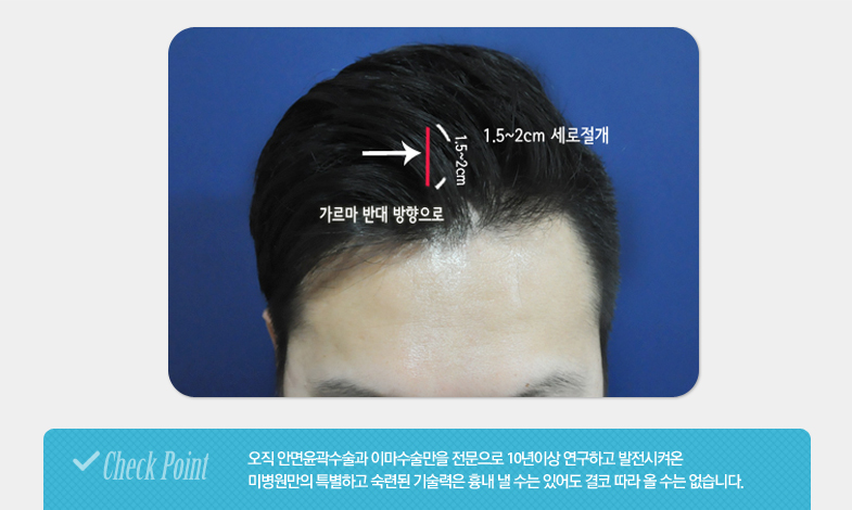 오직 안면윤곽수술과 이마수술만을 전문으로 10년이상 연구하고 발전시켜온 미병원만의 특별하고 숙련된 기술력은 흉내 낼 수는 있어도 결코 따라 올 수는 없습니다.