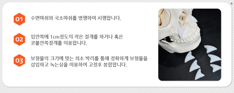 수면마취와 국소마취를 병행하여 시행합니다. 입안쪽에 1cm정도의 작은 절개를 하거나 혹은 콧볼안쪽절개를 이용합니다. 보형물의 크기에 맞는 최소 박리를 통해 정확하게 보형물을 삽입하고 녹는실을 이용하여 고정후 봉합합니다.